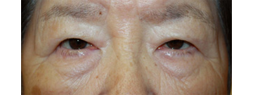 画像：皮膚弛緩性眼瞼下垂
