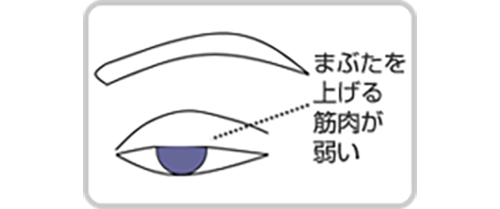画像：腱膜性眼瞼下垂症