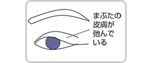 重症の腱膜性眼瞼下垂症